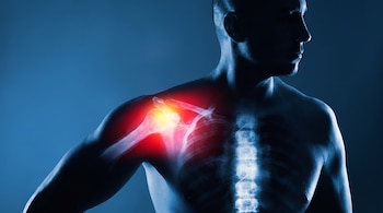 Hombre de perfil con una superposición de radiografía de su torso. Se observan huesos del hombro, brazo y columna vertebral con un área rojiza en el hombro.