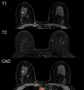 15-08-2021 Ejemplo de resonancia magnética falsa positiva.
SALUD
RADIOLOGICAL SOCIETY OF NORTH AMERICA