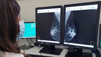 Die Mammographie kann Hinweise zur