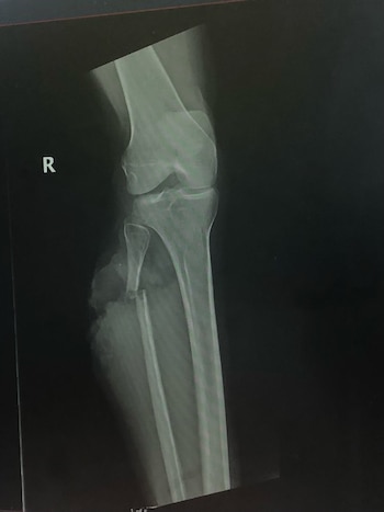 Rachél Thompson sufrió una mordedura