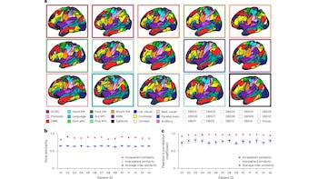 Grid de 15 modelos cerebrales 3D multicolores con regiones funcionales etiquetadas, acompañados de dos gráficos que muestran la similitud de datos por paciente