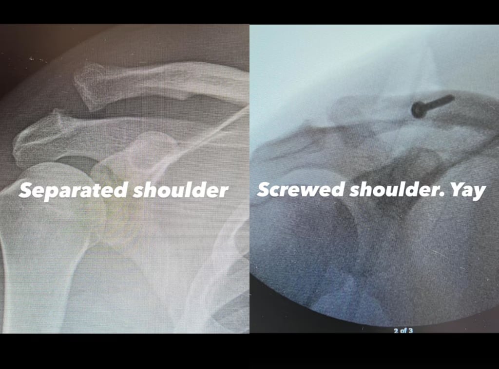 El protagonista de Magic Mike mostró radiografías de su hombro y confirmó que la lesión fue reparada quirúrgicamente. (Instagram: Channing Tatum)