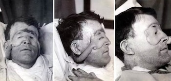 Las fotografías de su caso se convirtieron, un siglo más tarde, en algunas de las imágenes médicas más compartidas de internet