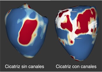 Imagen de un corazón con fibrosis.