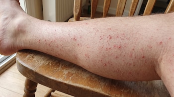 Pierna de una persona apoyada en una silla de madera con pequeñas protuberancias rojas en la piel.