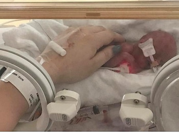 La bebé pesó 340 gramos