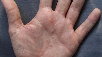 La dishidrosis se presenta como ampollas llenas de líquido en la palma de la mano y entre los dedos. (Wikimedia Commons)