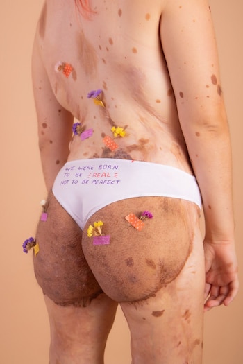 Imagen del nevus congénito melanocítico,