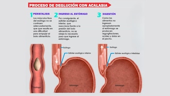 La acalasia esofágica impide que