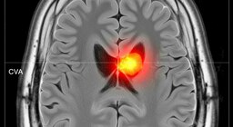 Por qué tras un ACV escuchar y entender palabras se vuelve más complejo, según un estudio