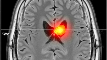 Los cinco síntomas que podrían