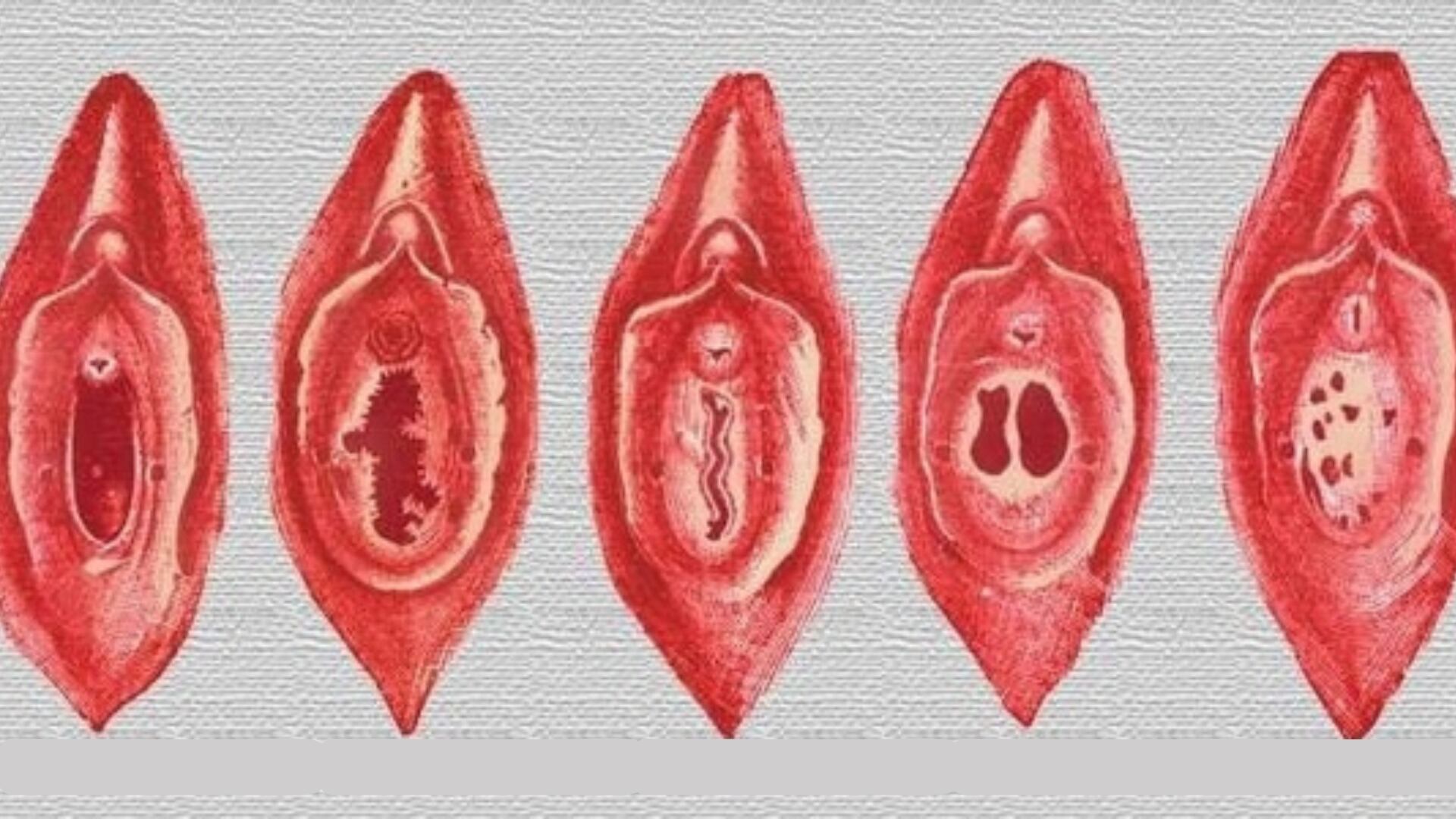 La himenoplastia se realiza uniendo los bordes rasgados del himen o creando una membrana nueva con tejido vaginal (Clínica Vecindario)