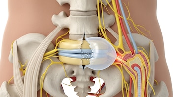 Minsa alerta sobre la ciática: principales causas, síntomas y recomendaciones para prevenir el dolor lumbar