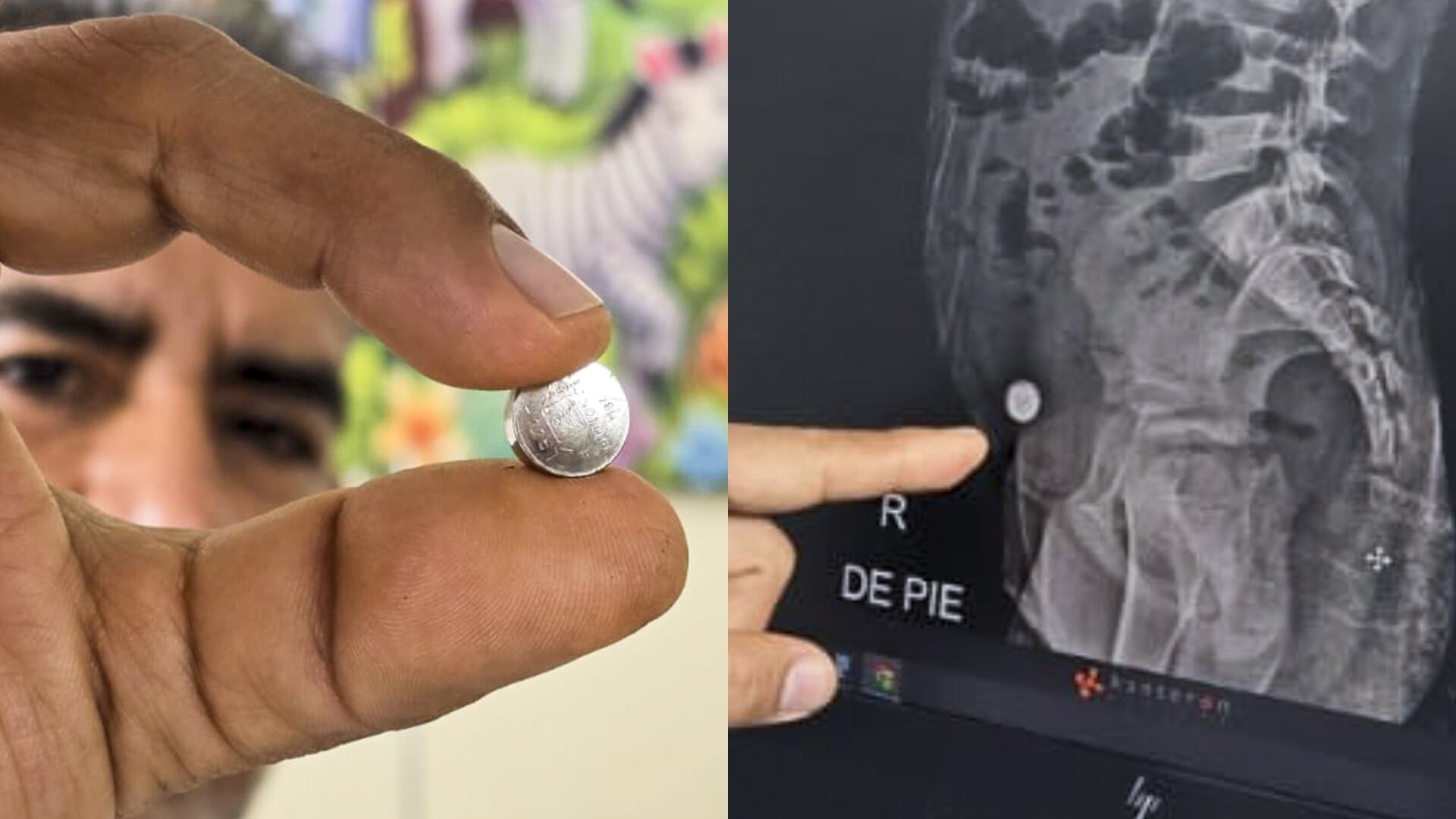 Hospital Sabogal salvó a menor tras extirparle una pila y parte del intestino delgado| EsSalud