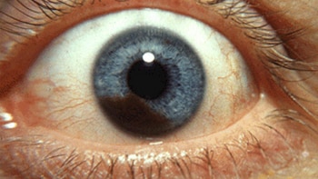 Melanoma uveal: ¿cuáles son los síntomas del cáncer ocular que puede avanzar sin molestias?