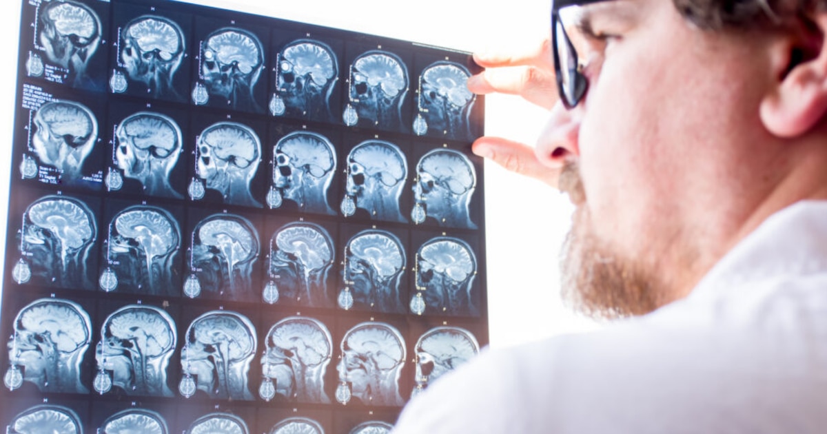 IA pode encontrar o dispositivo IA para encontrar um distúrbio cerebral duro que é difícil de identificar crianças com epilepsia IA pode encontrar o dispositivo IA para encontrar um distúrbio cerebral duro que é difícil de identificar crianças com epilepsia