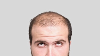 Caída del cabello: mitos, causas