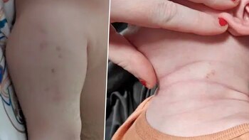 Dos bebés tenían moretones y