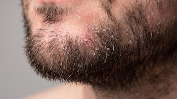 Plano macro de una barba masculina corta con vello oscuro, escamas blancas de caspa, piel enrojecida y gotas de agua en la base del vello.