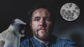 La viruela del mono se