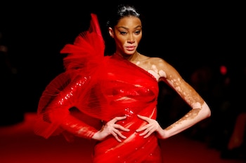 Su vitiligo y autenticidad han