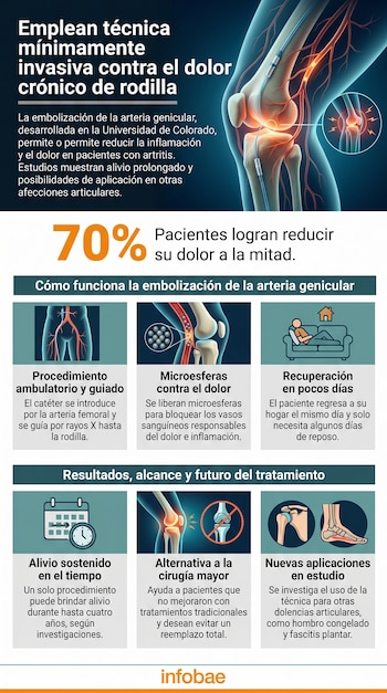 Infografía con título y texto sobre embolización de arteria genicular, diagrama de rodilla con catéter, esquemas del procedimiento y sus etapas, porcentaje de alivio.