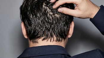 Vista desde atrás de la nuca y el cabello graso de un hombre con traje azul que pasa sus dedos por la coronilla.