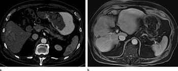El hepatocarcinoma celular es el