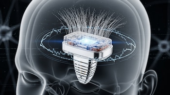 Implante cerebral inalámbrico para tratar la depresión comenzará a probarse en humanos: así funciona