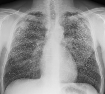 Radiografía de tórax de frente en escala de grises con huesos, costillas, hombros, corazón y pulmones con numerosas opacidades nodulares
