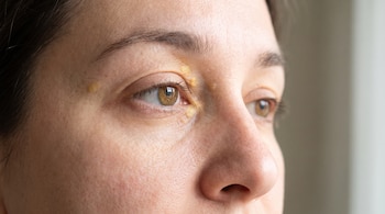 Primer plano del rostro de una persona con depósitos amarillos en la piel alrededor de los ojos y cerca del lagrimal.