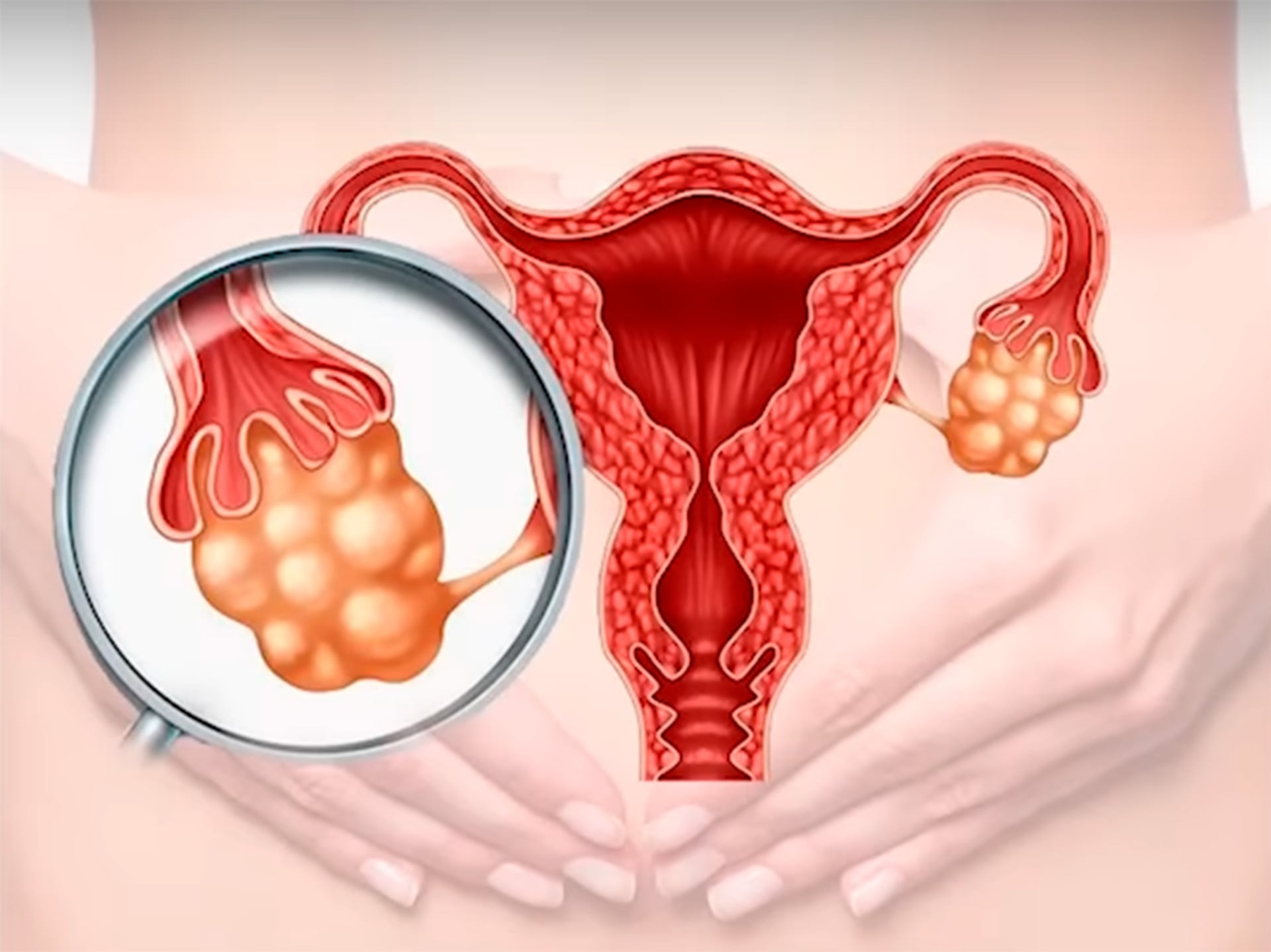 El síndrome de ovario poliquístico se caracteriza por la presencia de múltiples quistes en los ovarios y desequilibrios hormonales (Freepik)