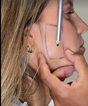 Ale Baigorria se aplica bótox tras ser diagnosticada con bruxismo en medio de rumores de separación. Captura: @alejandrabaigorria.