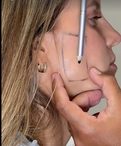 Ale Baigorria se aplica bótox tras ser diagnosticada con bruxismo en medio de rumores de separación. Captura: @alejandrabaigorria.