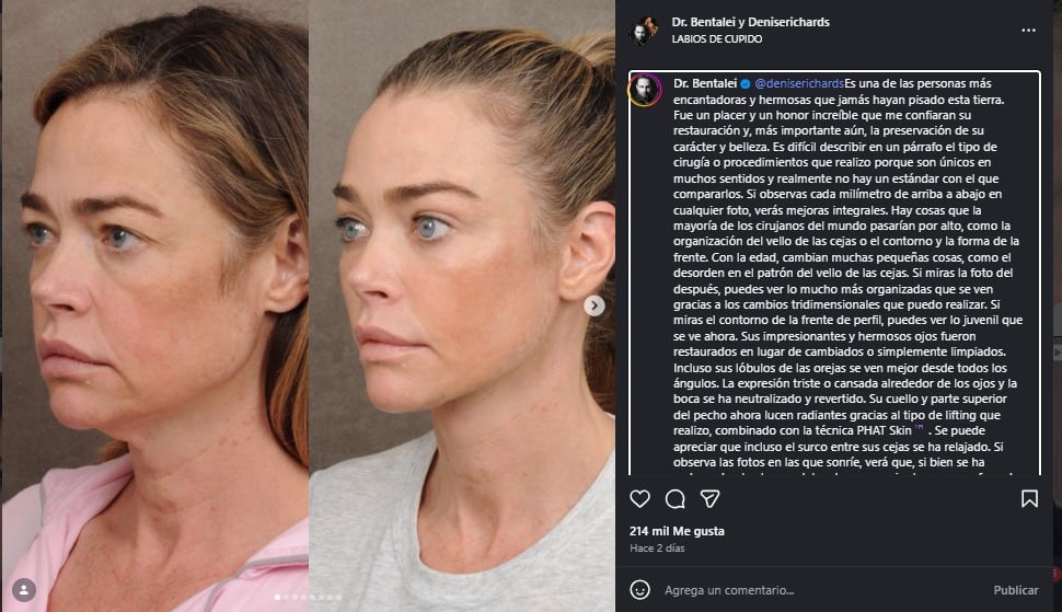 El doctor Ben Talei explicó los cambios en el rostro de Denise Richards. (Instagram)