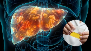 Daño hepático severo: la principal señal de alarma que se detecta en tu orina