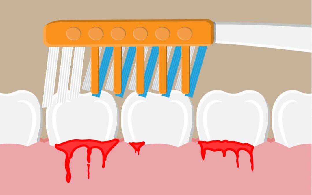 Ilustración de un cepillo pasando por unos dientes con gingivitis - Salud dental e higiene bucal (Clínica Dental Koresdent)