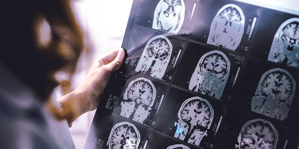 La IA puede detectar cicatrices de esclerosis múltiple en el cerebro que antes eran invisibles
