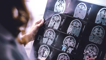 La IA puede detectar cicatrices de esclerosis múltiple en el cerebro que antes eran invisibles