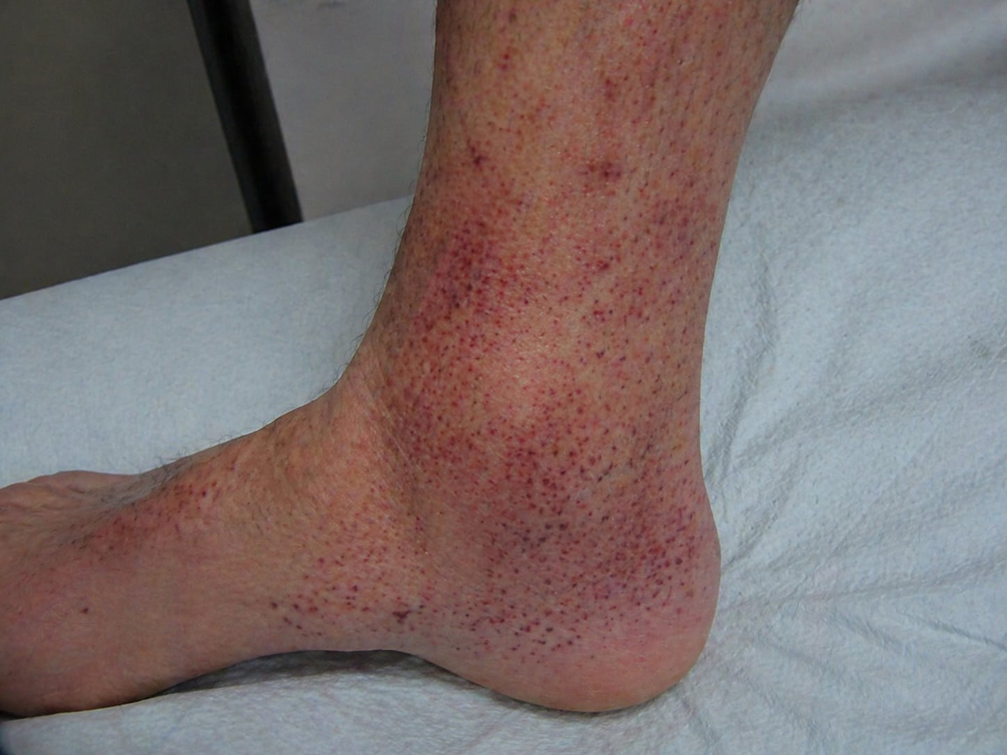 Pie con vasculitis. (Imagen ilustrativa Infobae)