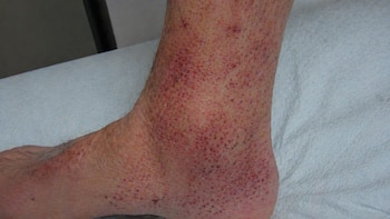 Vasculitis: qué es, consecuencias para la salud, síntomas y cómo tratarlo