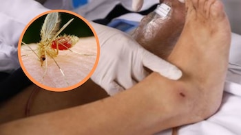 Uta en Perú: ¿Qué es,