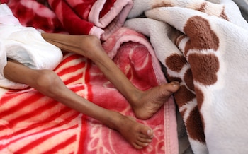 Una niña desnutrida en el hospital al-Sabeen de Sanaa, Yemen (REUTERS/Khaled Abdullah)
