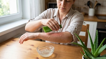 Una persona aplica el gel de una hoja de sábila verde sobre una quemadura en su antebrazo, con un cuenco de gel de aloe vera en una mesa de madera.