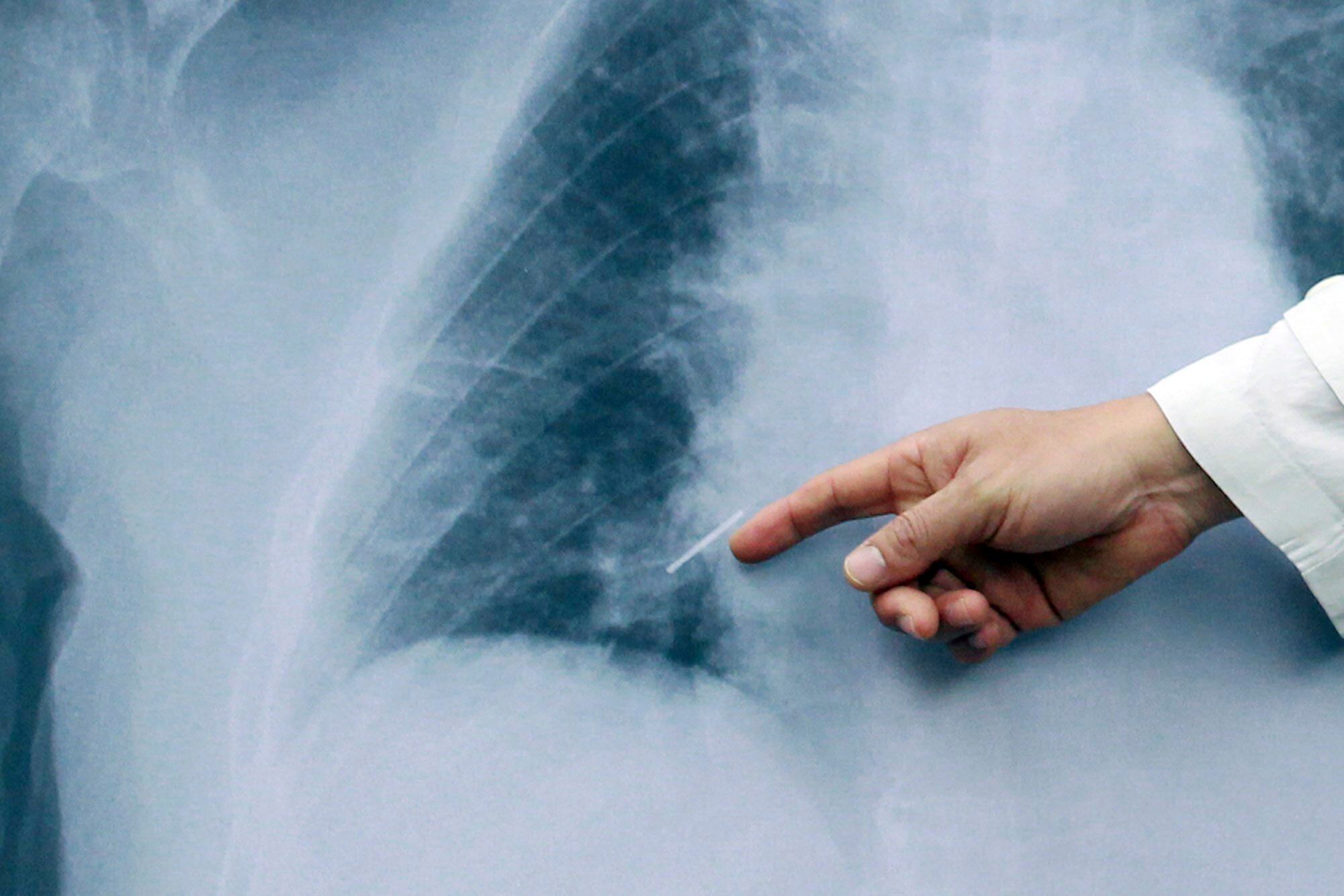 El avance se publica en Science Advances y abre el camino para investigar afecciones como el cáncer de pulmón y enfermedades respiratorias raras/EFE/STRINGER/Archivo