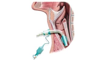 Así luce una traqueostomía (Foto: