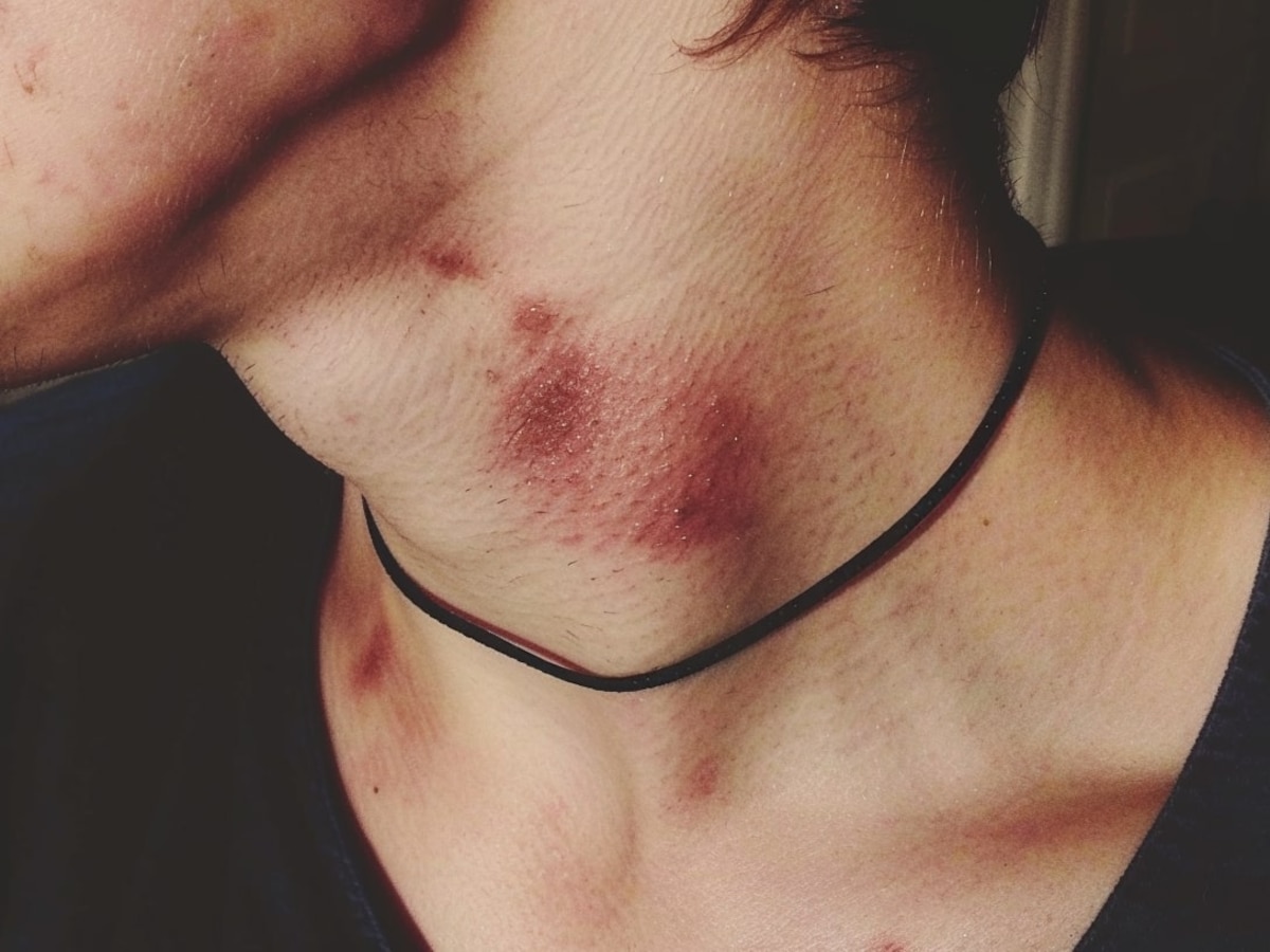 Chupetones” en el cuello: cuatro plantas que ayudan a borrarlos de forma natural - Infobae