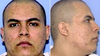 Dos fotografías de la cabeza de un hombre con la cabeza rapada y marcas en la piel, una de frente y otra de perfil derecho