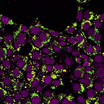 Tejido de cáncer de mama después del tratamiento con sildenafil. El colesterol (verde) queda atrapado dentro de unos pequeños orgánulos en forma de saco llamados lisosomas, lo que impide que las células cancerosas lo absorban