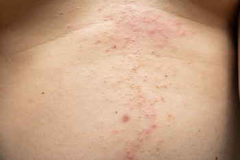 Brote de miliaria en el estómago (AdobeStock)